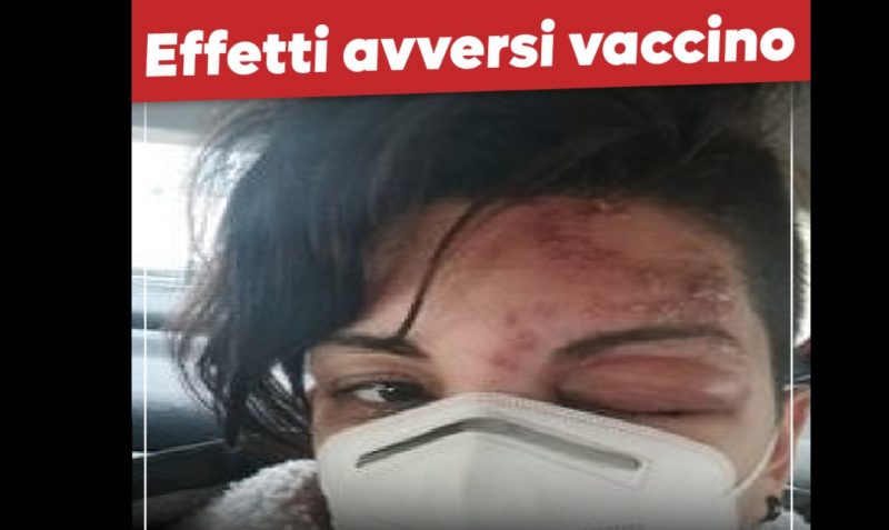 Sanità Da Incubo In Calabria “ho Avuto Reazione Allergica Al Vaccino Ma Sono Stata Rifiutata 1006