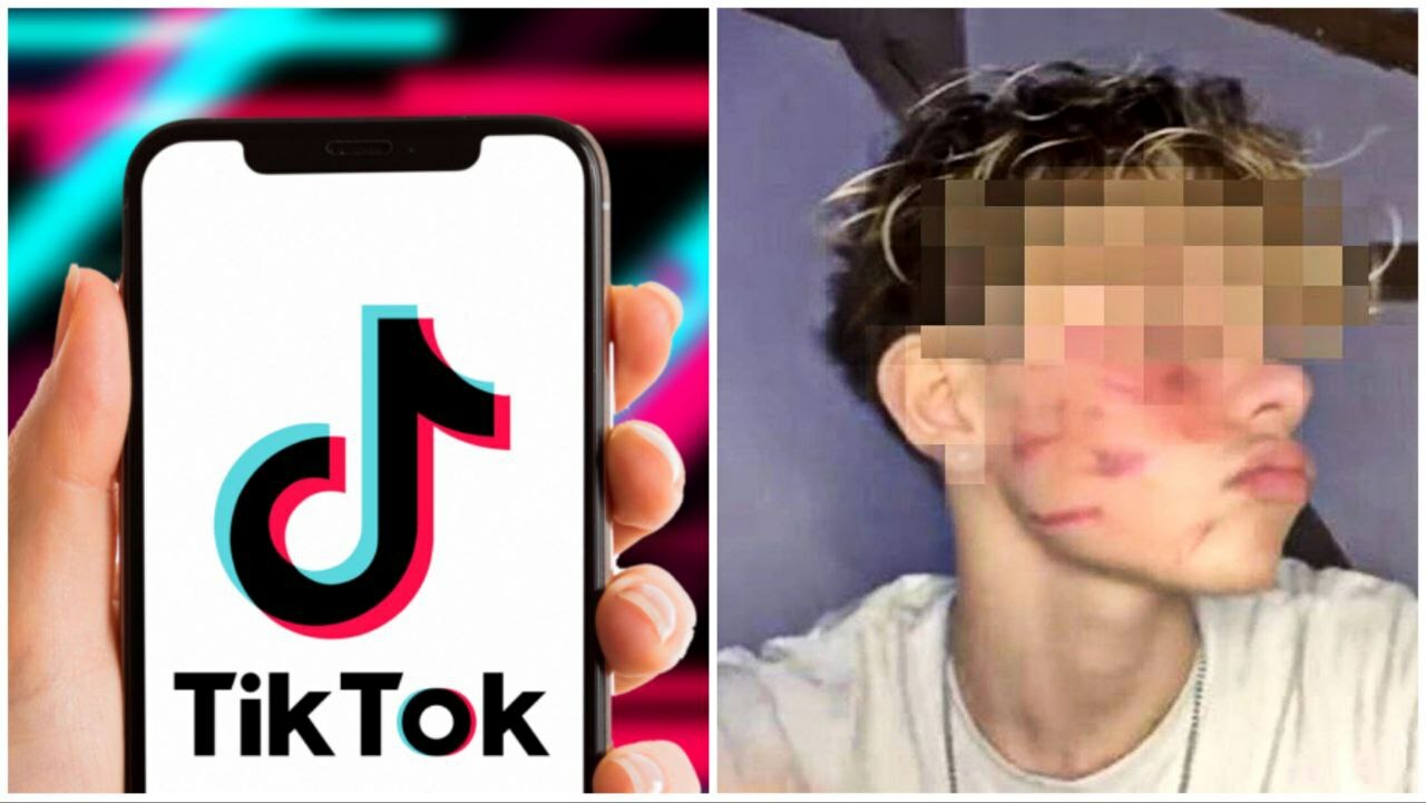 Che Cos La Cicatrice Francese Su Tiktok I Ragazzi Si Sfigurano Il Viso